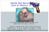 HERIDAS BUCO MAXILO FACIALES A CAUSA DE ARMA DE FUEGO