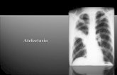 Colapso parcial o total de tejido pulmonar que previamente estuvo dilatado, afectando todo el pulmón o una parte del mismo  Otra definición:  Pérdida.
