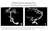Aneurisma pequeño (Tratamiento endovascular) Vemos en azul dibujado el aneurisma en la cara posterior de la A. Basilar, no fue visualizado en la ASD 2D.