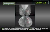 Mamografía MD: nódulo en CIE de contornos espiculados. MI: dos nódulos de bordes mal definidos en intercuadrantes y en unión de cuadrantes externos. CASO.