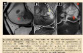 OSTEOBLASTOMA de rodilla. Paciente de 28 años sintomática. A, B y C) Imágenes sagitales en T1 y T2, eco de gradiente y coronal en STIR; mostrando una lesión.