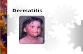 Dermatitis. Dermatitis Es una inflamación de la piel causada por la exposición a una sustancia irritante. El grado de inflamación es afectado por el tipo.