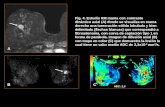 A B C ADC: 2,3 Fig. 4. Estudio RM mama con contraste dinámico axial (A) donde se visualiza en mama derecha una tumoración sólida lobulada y bien delimitada.