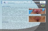 PRIMOINFECCIÓN DE HERPES  SIMPLEx  TIPO I