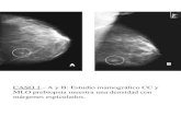 CASO 4 .- D y E: Magnificaciones de la lesión detectada en el estudio radiológico de control.