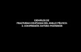 EJEMPLOS DE  FRACTURAS COMPLEJAS DEL ANILLO PÉLVICO: 3. COMPRESIÓN ÁNTERO-POSTERIOR