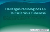 Hallazgos radiológicos en la Esclerosis Tuberosa