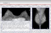 Paciente de alto riesgo con mamas densas, difícil de evaluar por mamografía (a; b).