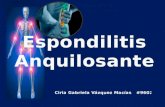 Espondilitis  Anquilosante