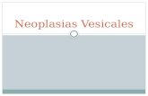 Neoplasias Vesicales