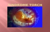 SINDROME TORCH