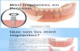 Mini Implantes en Prótesis.pptx