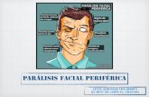 Parálisis facial periférica en Urgencias