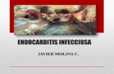 Endocarditis infecciosaa