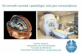 El cervell normal i patològic vist per ressonà · PDF fileOlfactori (16 w) Parieto-occipital (19 w) Sup. temporal (32 w) Orbitofrontal (36-39) Creixement intrauteri Creixement extrauterí