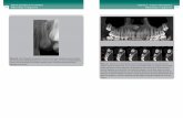 Atlas de patología de los maxilares 170 Odontoma · PDF fileCompromete desde la pared lateral de fosa nasal y piso de seno maxilar hasta el borde marginal. ... – Desplazamiento
