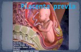 Presentación de PowerPoint… · PPT file · Web view · 2013-09-09Definición. Placenta previa es aquella. que se implanta y desarrolla en el segmento inferior del útero ,ocluyendo