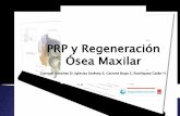 PRP y Regeneración Ósea Maxilar - A.N.E.H. · PRP y Regeneración Ósea Maxilar Carvajal Sánchez D, Iglesias Estévez E, Garrote Bogo S, Rodríguez Galán N.