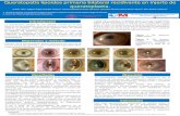 Queratopatía lipoidea primaria bilateral recidivante en ...sociedadoftalmologicademadrid.com/revistas/revista-2015/m2015-27.pdf · distrofia corneal sobre el injerto. A pesar de
