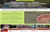 CURACIÓN de las UÑAS DESCOLORIDAS … · una curación total de la infección de hongos en las uñas del pie de diabético evitando sobreinfección posterior y ... HONGOS en PIE