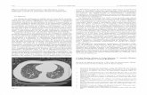 Micronódulos pulmonares calcificados como hallazgo …scielo.isciii.es/pdf/ami/v24n3/carta4.pdf · La afectación pulmonar en adultos por el virus de la ... Mujer de 37 años con