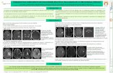 ENFERMEDADES DESMIELINIZANTES P1 Grau … · tratados con fibrinolisis por lo que la neuroimagen es esencial para establecer un correcto diagnóstico 'Las características radiológicas