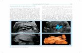 Ecocardiografía Fetal y Doppler 191media.axon.es/pdf/80760_1.pdf · 2010-10-26 · Doble salida de ventrículo derecho. A) modo B, B) ... En el doble tracto de salida del ventrículo