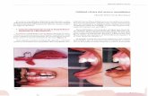 Utilidad clínica del avance mandibular - barcelona.dental · cuando se producen cambios posturales, las contrac ciones musculares del sistema estomatognático cambian la posición