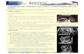 AGENESIA DE CUERPO CALLOSO: A PROPÓSITO DE UN · RMN: Microcefalia, con disminución de lóbulos frontales (FIGURA 2) , ... colpocefalia con agenesia parcial de cuerpo calloso ;