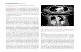 Trombosis de aorta estructuralmente sana con embolia sistémica · mesentérica, se realiza laparotomía exploradora que descarta dicho diagnóstico. La paciente evoluciona tórpidamente