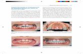 Aparato Removible en Tratamiento de un Diastema Causado ...media.axon.es/pdf/88942_3.pdf · Manejo de los Diastemas en Incisivos 143 Aparato Removible en Tratamiento de un Diastema