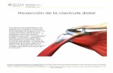 Resección de la clavícula distal - traumatologiapenta.com.artraumatologiapenta.com.ar/docs/pacientes/hombro/Reseccion de la... · Introducción de resección de la clavícula distal