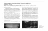 Fibroadenoma gigante.Presentación de un casorevistapediatria.com.ar/wp-content/uploads/2012/03/con223-193.pdf · Octubre 2008 193 Introducción El fibroadenoma es una lesión benigna