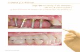 Ciencia y práctica · 2012-07-19 · 1.Fase higiénica periodontal para tratar la gingivitis e ins-truir al paciente en higiene oral. Colocación de un puen-te provisional superior