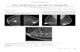 Unas calcificaciones especiales en mamografiascielo.isciii.es/pdf/sm/v74n3/1887-8571-sm-74-03-00185.pdf · nes y microcalcificaciones, con el fin de detectar cáncer de mama. Con