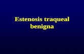 Estenosis traqueal benigna · •Evaluar siempre con broncoscopía. CONCLUSIONES •Siempre realizar una evaluación prequirúrgica de la glotis. •El tratamiento de elección es