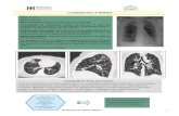 LA IMAGEN DE LA SEMANA - hospitalitaliano.org.ar€¦ · ocluyen la vía aérea, y vasos linfáticos y sanguíneos, lo que lleva a una pérdida progresiva de la función pulmonar
