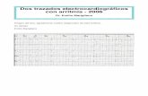 Dos trazados electrocardiográfcos con arritmia - 2006fiaiweb.com/wp-content/uploads/2017/10/Dos-trazados-electrocardio… · 62 x min (inspiración), además va con con latidos ventriculares