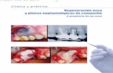 Ciencia y práctica - maxillaris · 2012-07-19 · Ciencia y práctica Fig. 1. Proceso fistuloso crónico y tinción por amalgama de la encía adherida debido a una apicectomía defectuosa