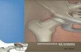 ARTROSCOPIA DE CADERA - Remeco · biomecánica de la cadera, y al retardo o a la eliminación de la necesidad de una sustitución completa de la cadera. Stryker está a la cabeza