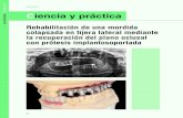 Rehabilitación de una mordida colapsada en tijera lateral … · 2020-05-05 · Mordida de la paciente sin las prótesis, ... La estructura puede ser probada en la paciente con una