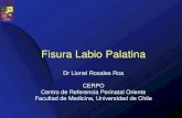 Fisura Labio Palatina - CERPO · Embriología • La patogenia ocurre desde la cuarta semana de gestación cuando se produce la formación de la prominencia frontonasal, los procesos
