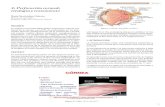 4. Perforación corneal: etiología y tratamiento · 2020. 4. 20. · generación del tejido corneal y de su transparencia.43,45,50 La perforación de la córnea es una causa de morbilidad
