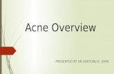 Acne presentation